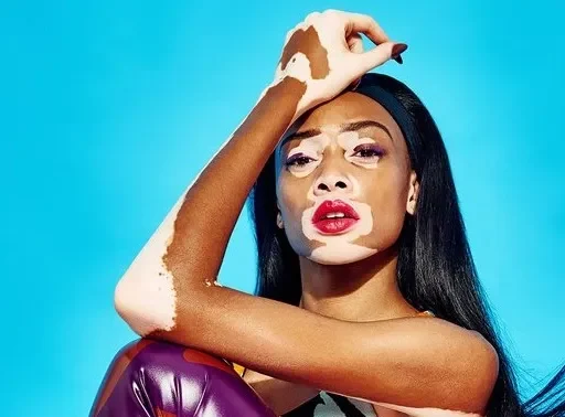 The Inspiring Story of Winnie Harlow: Redefining Beauty Standards