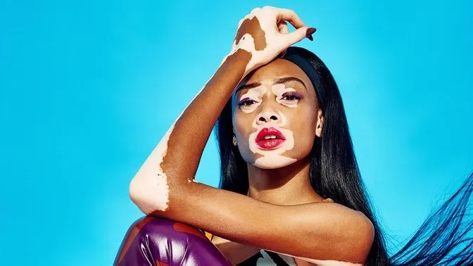 The Inspiring Story of Winnie Harlow: Redefining Beauty Standards